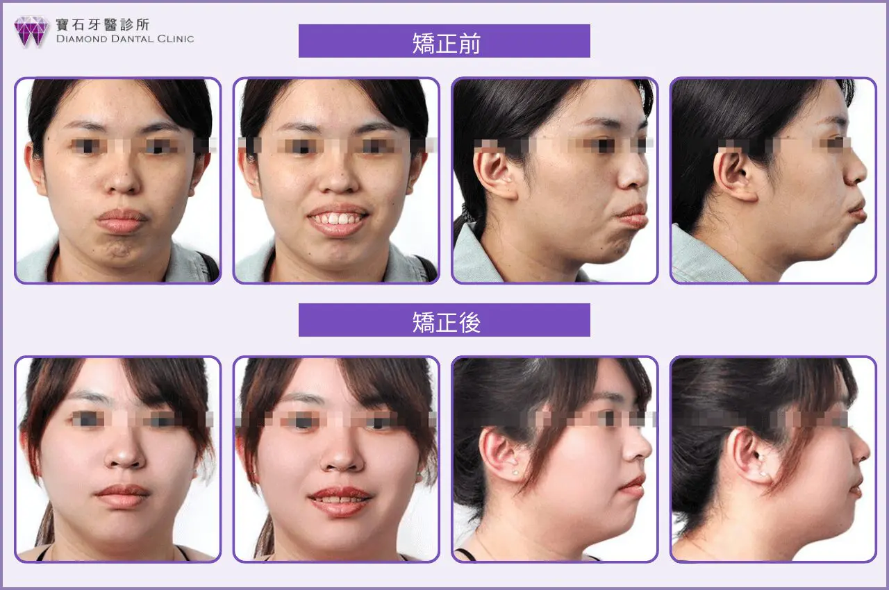 嚴重骨性暴牙