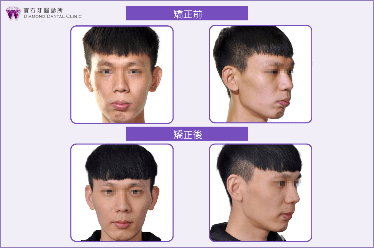 中度齒性暴牙