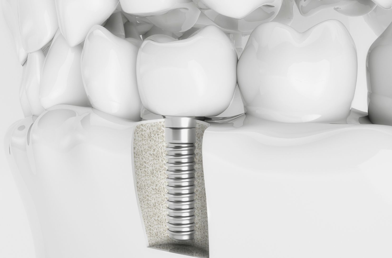 denture01