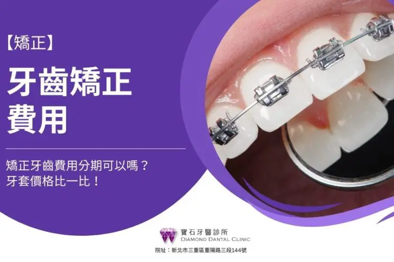 牙齒矯正費用多少錢?矯正牙齒費用分期可以嗎?牙套價格比一比!