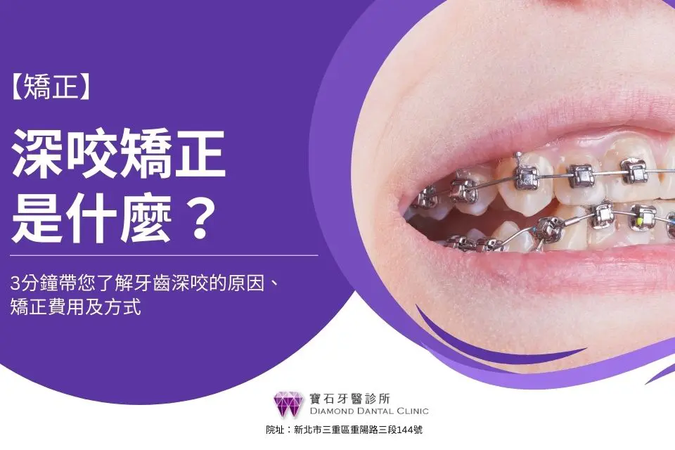 深咬矯正是什麼？3分鐘帶您了解牙齒深咬的原因、矯正費用及方式