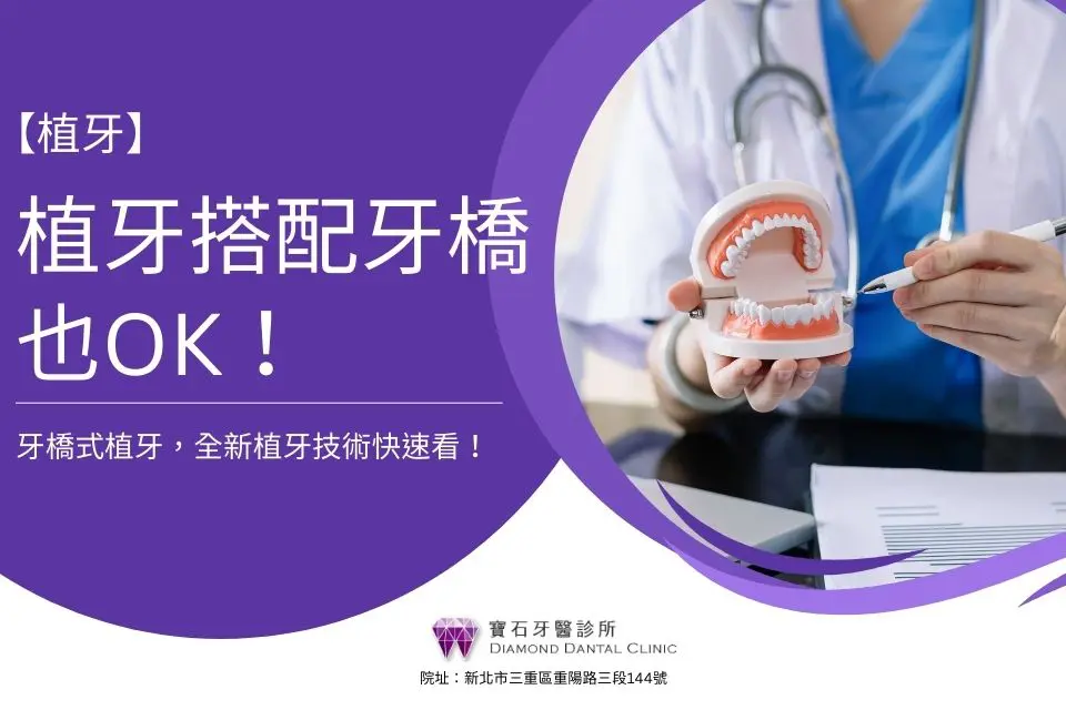 牙橋式植牙,植牙搭配牙橋也ok,全新植牙技術快速看!