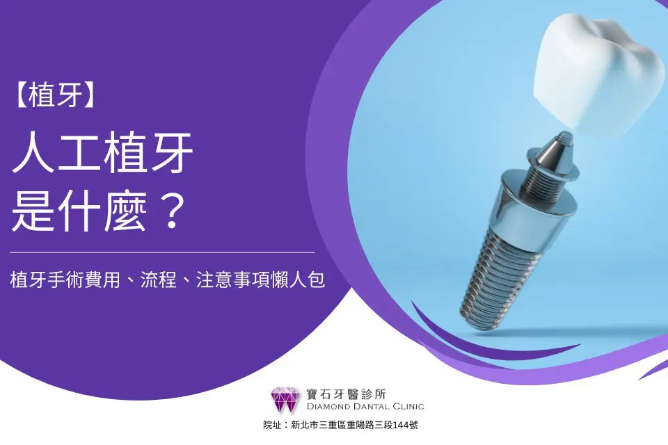 人工植牙是什麼？植牙手術費用、流程、注意事項懶人包