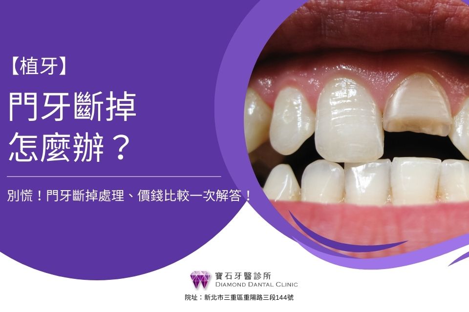 門牙斷掉怎麼辦?別慌!門牙斷掉處理、價錢比較一次解答!