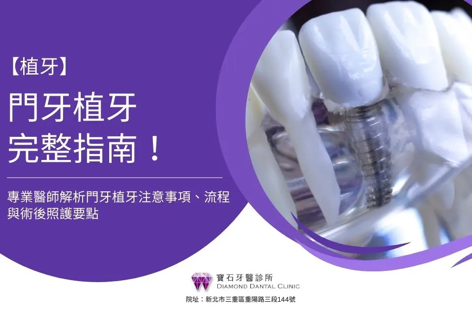 門牙植牙完整指南！專業醫師解析門牙植牙注意事項、流程與術後照護要點