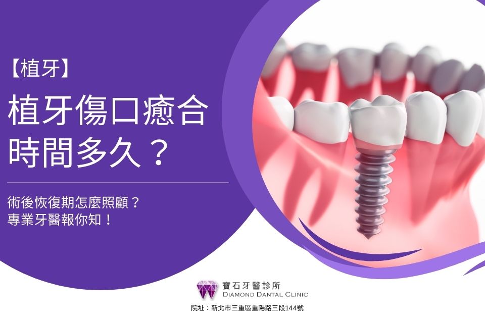 植牙傷口癒合時間多久?術後恢復期怎麼照顧?專業牙醫報你知!