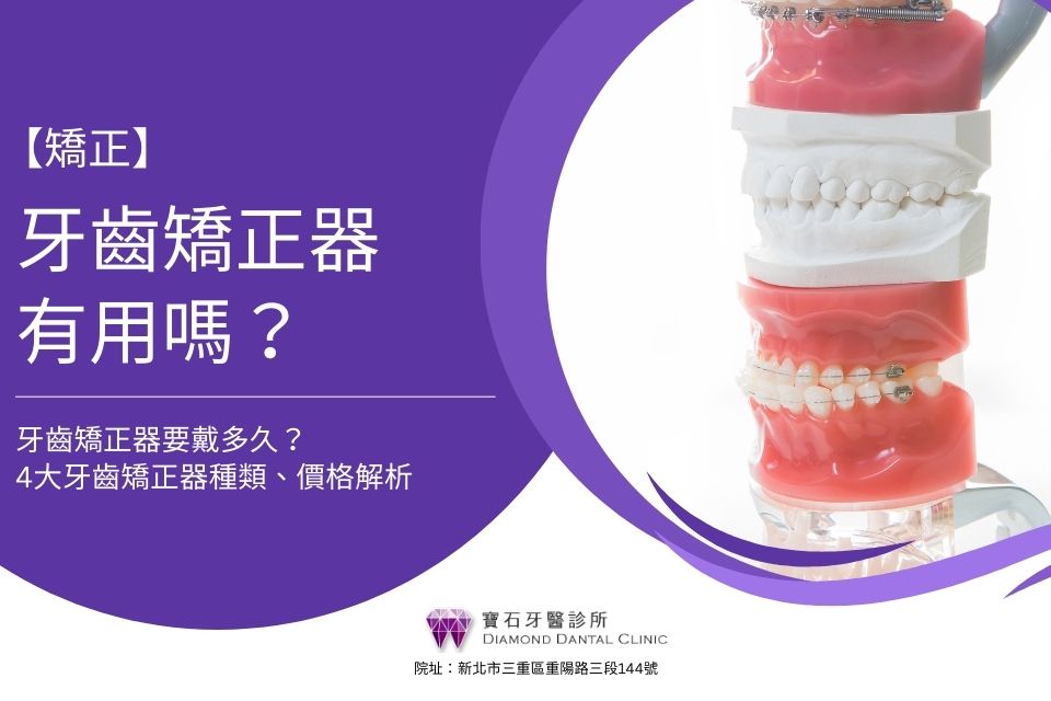 牙齒矯正器有用嗎?牙齒矯正器要戴多久?4大牙齒矯正器種類、價格解析