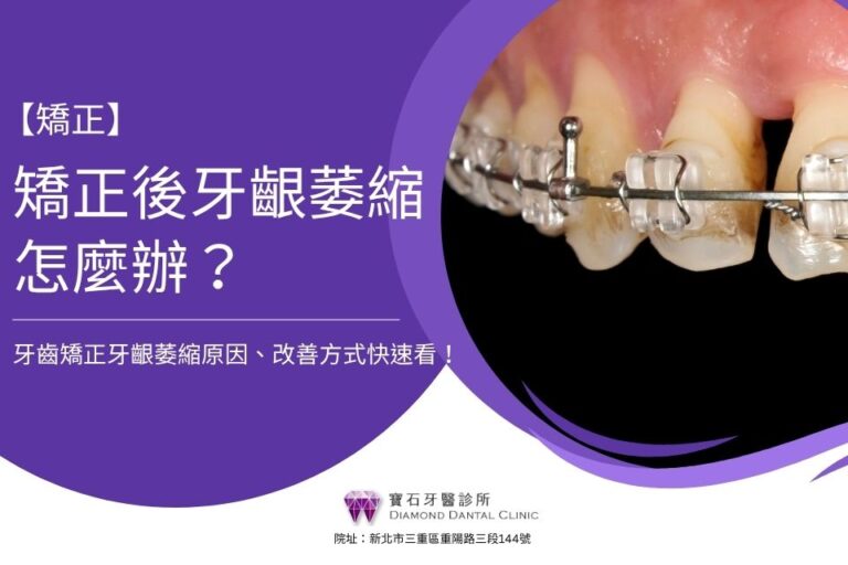 矯正後牙齦萎縮怎麼辦？牙齒矯正牙齦萎縮原因、改善方式快速看！