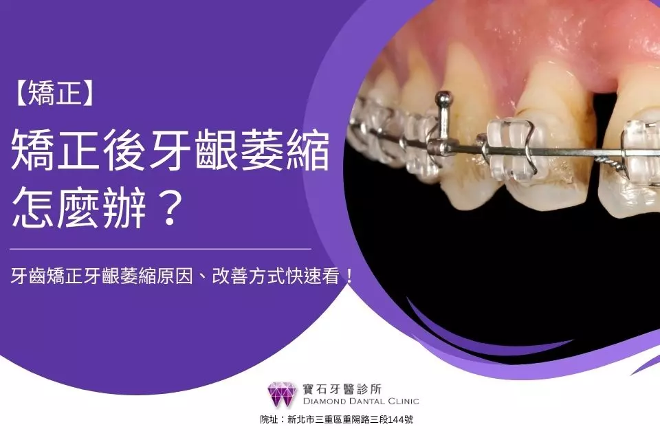 矯正後牙齦萎縮怎麼辦?牙齒矯正牙齦萎縮原因、改善方式快速看!