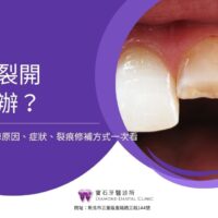 牙齒裂開怎麼辦？6大牙齒裂掉原因、症狀、裂痕修補方式一次看