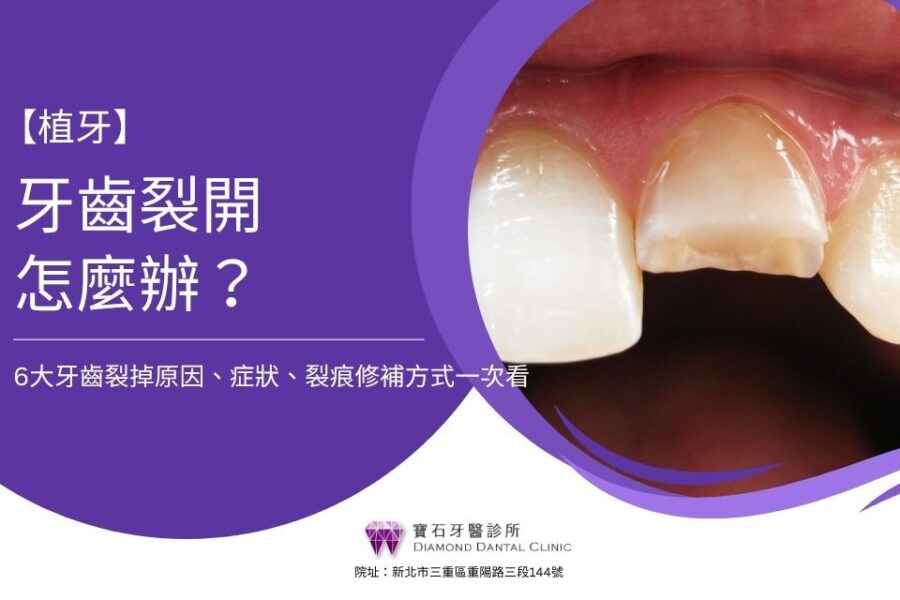 牙齒裂開怎麼辦？6大牙齒裂掉原因、症狀、裂痕修補方式一次看