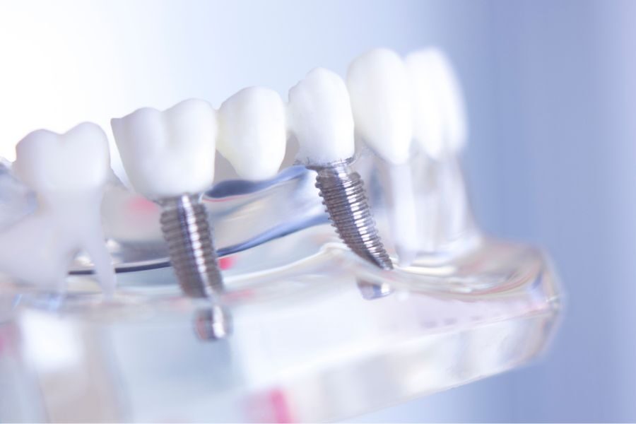 植牙後遺症、植牙風險有哪些？如何避免？裝假牙比較好嗎？專科醫師來解答