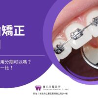 牙齒矯正費用多少錢？矯正牙齒費用分期可以嗎？牙套價格比一比！